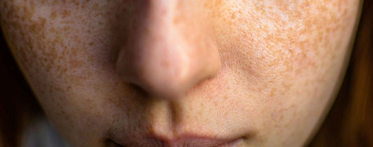 5 Signs You Have Sensitive, Selective Skin (and What to Do About It)